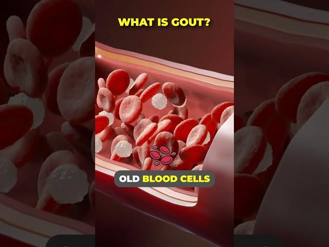 WHAT IS GOUT? #shorts #shortsfeed #gout