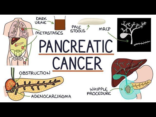 Understanding Pancreatic Cancer