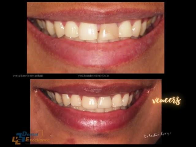 Dental Veneers