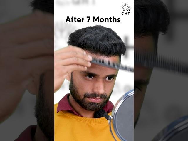 Seven Months Hair Transplant Results | Latest Fue Technique #shorts #viral #hair transplant