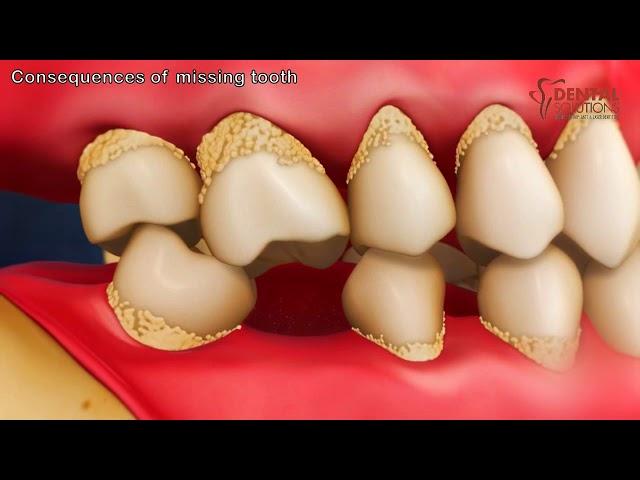 What are the consequences of missing teeth?