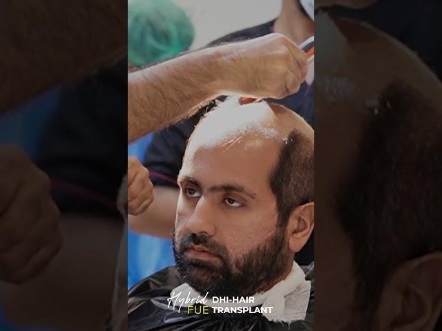 Today's procedure at Hair Club: FUE Hair Transplant with DHI technology.