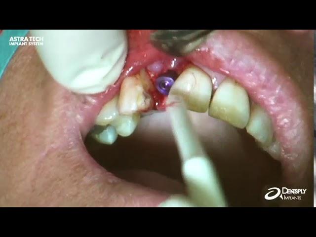 HealDesign™ EV Triangular – Installation | Dentsply Sirona