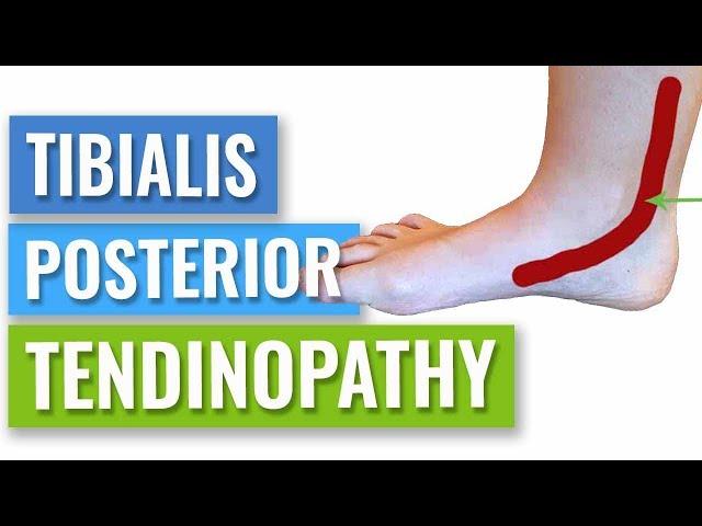 How to Get Rid of Posterior Tibial Tendonitis