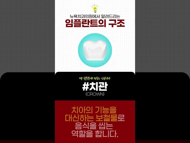 뉴욕치과의원에서 알려드리는 임플란트의 구조!  #대구동구치과 #임플란트