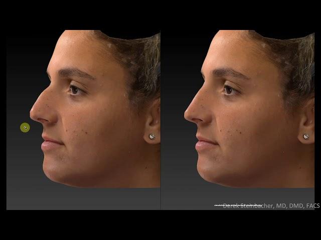 Rhinoplasty. 3D analysis simulation & actual. Modern cosmetic nose job results