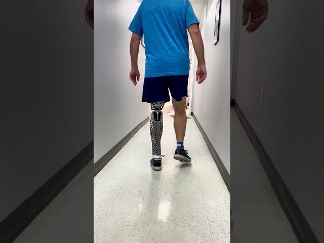 Scott Receives His New Prosthetic Leg at Our Denver Office - By Quorum Prosthetics