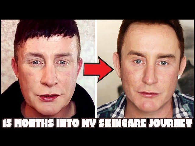 My Skincare Journey Before and After | 15-Months Progress | TJtutorials