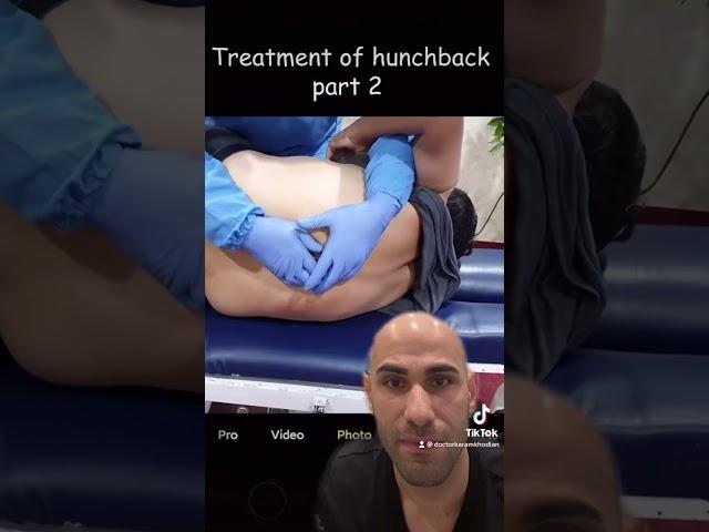 Chiropractic adjustment of severe hunchback! #chiropractor #hunchback #viral #fyp #parati #trending