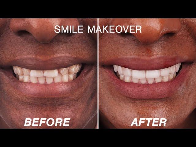 Before & After Smile Make-over Transformations 2022 | Cosmetic Dentistry Dental Boutique