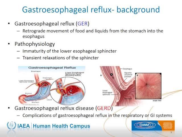 Nuclear Medicine Evaluation of Gastroesophageal Reflux and Pulmonary Aspiration in Children