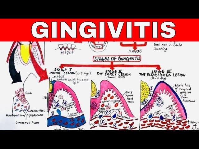 Gingivitis - Stages of Gingival Inflammation