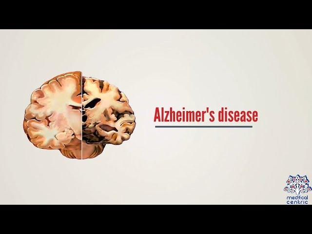 What is Alzheimer's disease? Causes, Signs and Symptoms, Diagnosis and Treatment.