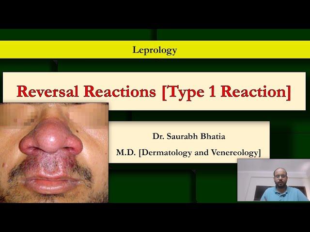 Reversal Reactions (Type 1 Lepra Reaction): Pathogenesis, grading, and features