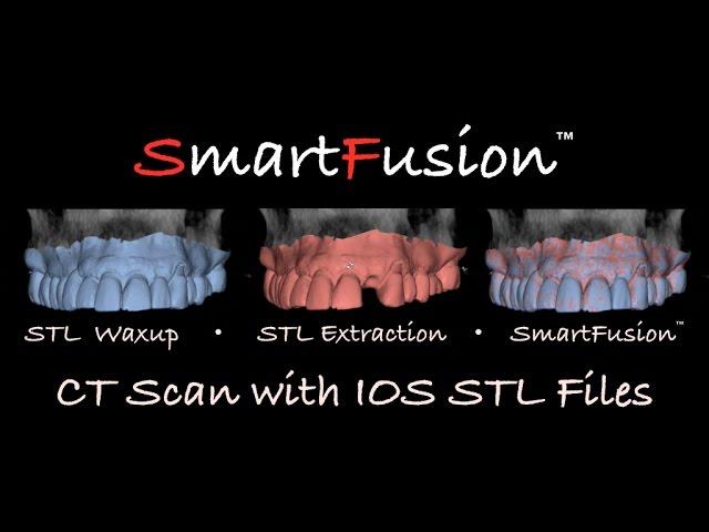 Intraoral scan for implant planning