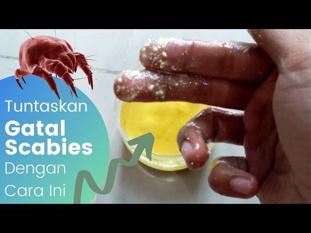 Gatal Karena Scabies⁉️Ini Solusinya‼️Anak Pondok, Anak Asrama, Anak Mana aja Merapat‼️