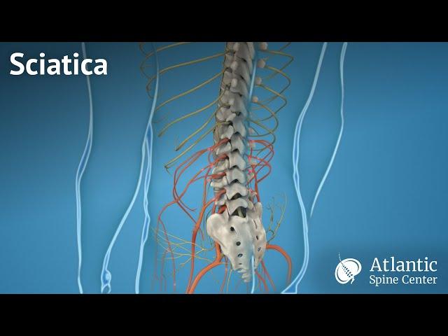 Sciatica