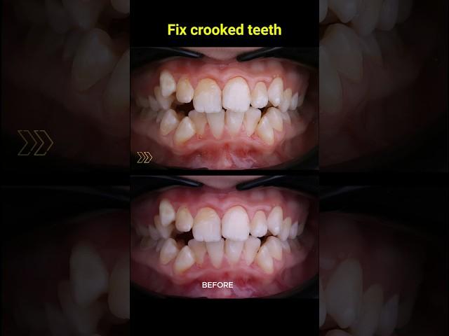 Fix crooked teeth, best braces #braces #orthodontist #dentist