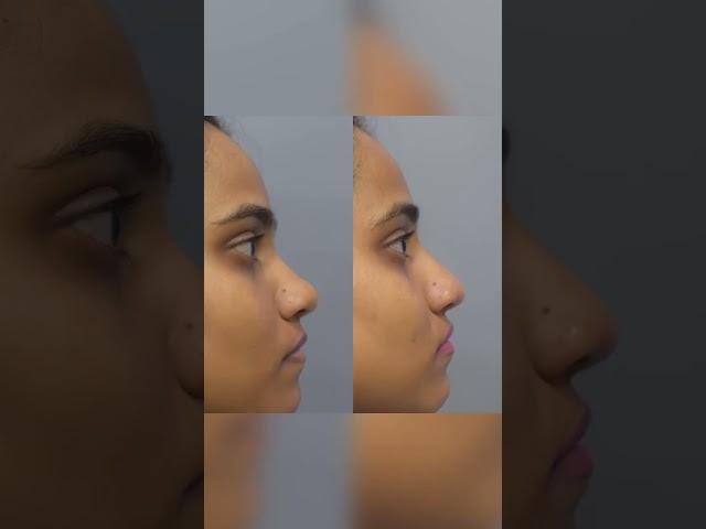 "The Future of Nose Reshaping: 5 Facts About Non-Surgical Rhinoplasty!"