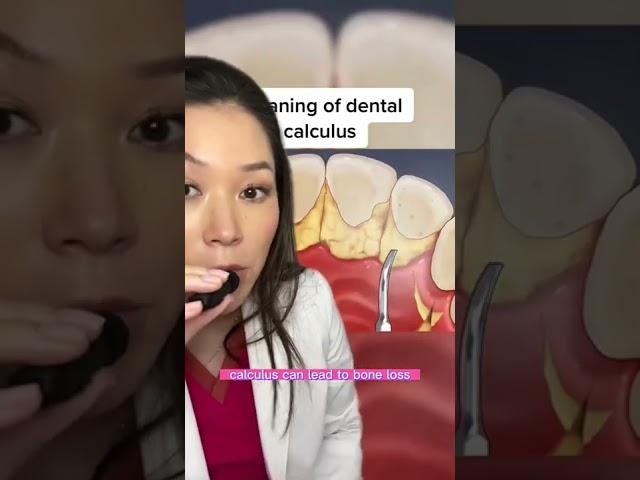 How a dental cleaning works. #dentist #cleaning #calculus