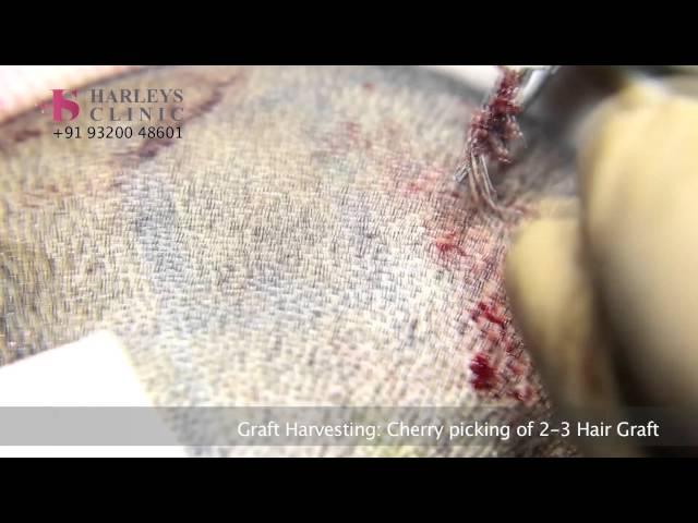 Harleys Clinic - How Follicular Unit Extraction (FUE) Procedure is Performed