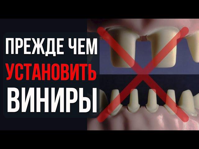 Виниры Всё, что нужно знать – виды, цена, установка и уход!