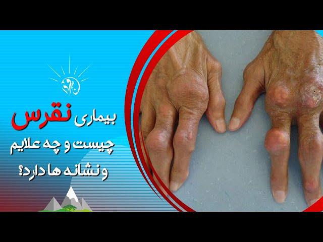 صبح فردا: بیماری نقرس چیست و چه علایم و نشانه ها دارد؟