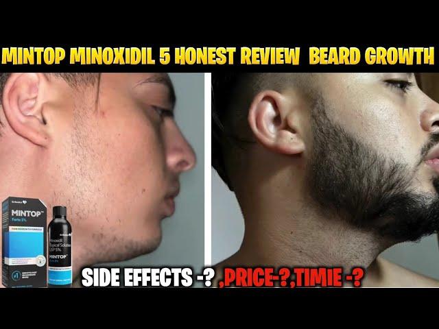 mintop minoxidil 5 beard growth result | best minoxidil for beard growth | minoxidil beard growth|