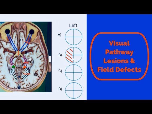Visual pathway lesions and field defects