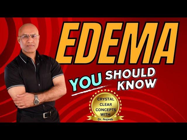 Edema | Types Causes and Symptoms‍️