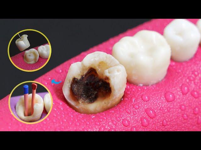 Amazing Root Canal Treatment And Onlay Restoration Of Carious Tooth In 4K.