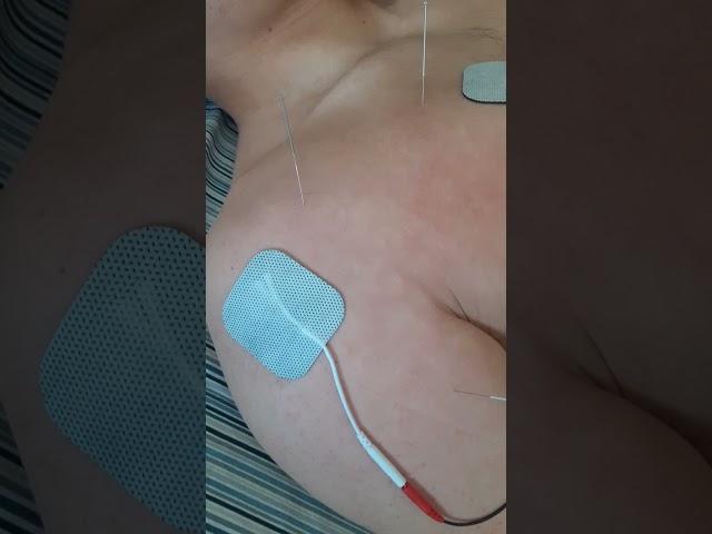 Acupuncture and electrical therapy