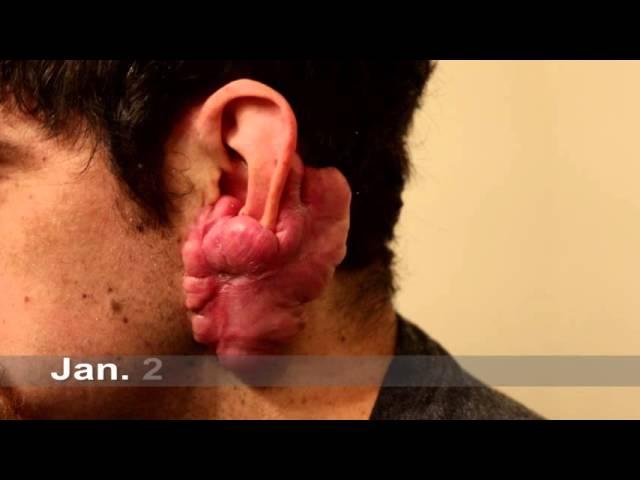 Keloid Treatment