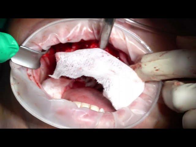 Zygomatic Surgery with ZAGA Approach