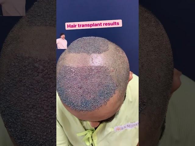  Hair Transplantation Result Before And After  #shorts