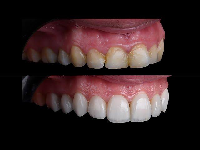 Trước và sau dán sứ Veneer #smiledesign #dental #nhakhoa