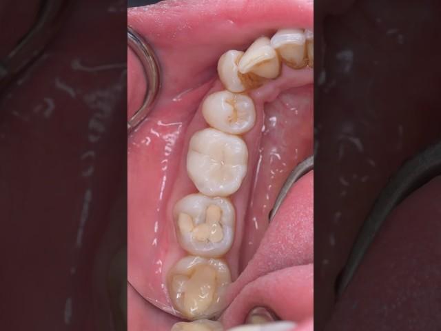 Same-day inlay or almost onlay restoration on an endo treated tooth #biomimetic #dentistry #dentist