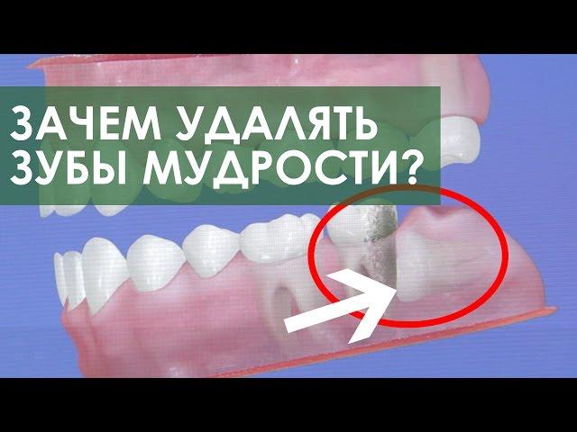 Удаление зубов мудрости. Стоматология ПрезиДЕНТ в Марьино