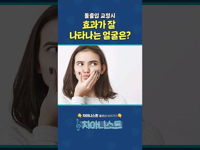 돌출입 교정시 효과가 잘 나다나는 얼굴은? #돌출입교정 #치아교정 #발치교정