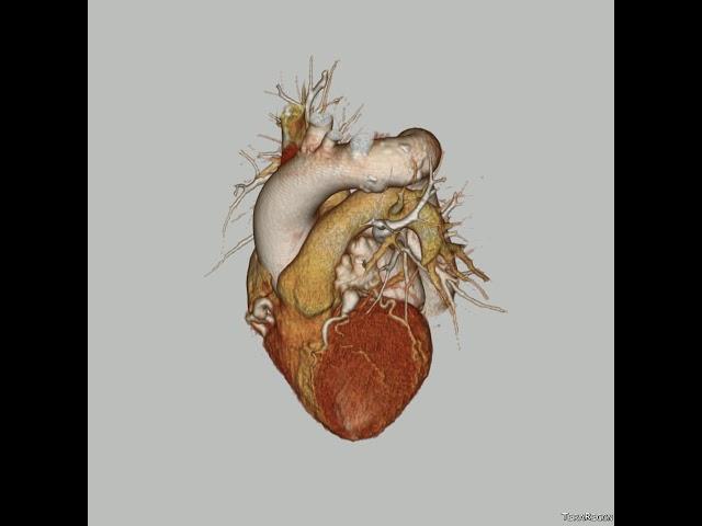Coronary artery aneurysms