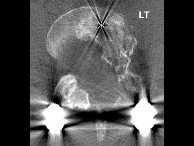 BMP Leaching Causes Horrible Sciatica: the Sad Tale of Tom and His 4 Failed Surgeries.