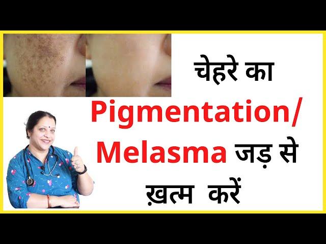 चेहरे की झाइयां ख़त्म करने का तरीका | pigmentation treatment on face | Melasma treatment