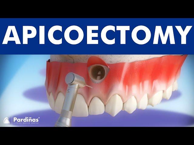 Apicoectomy - Treatment of root canal infection ©