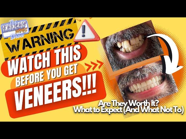 The KaleafWins Show-"Watch This Before You Get Veneers"
