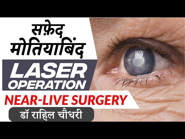 लेज़र से मोतियाबिंद का इलाज | Near Live Laser Cataract Surgery | No Blade, No Pain, No Injection