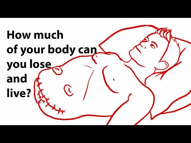 Amputation: How much can you lose & live?