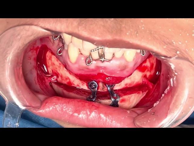 Jaw surgery with plates and screws - Maxillofacial And Orthognathic procedure