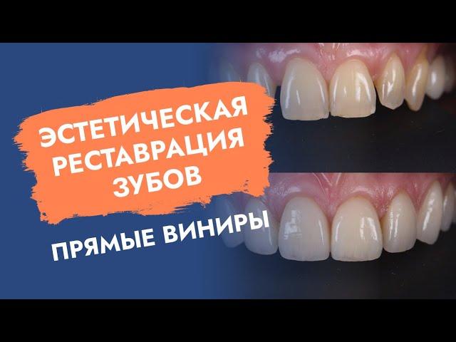 Эстетическая реставрация зубов: прямые виниры!