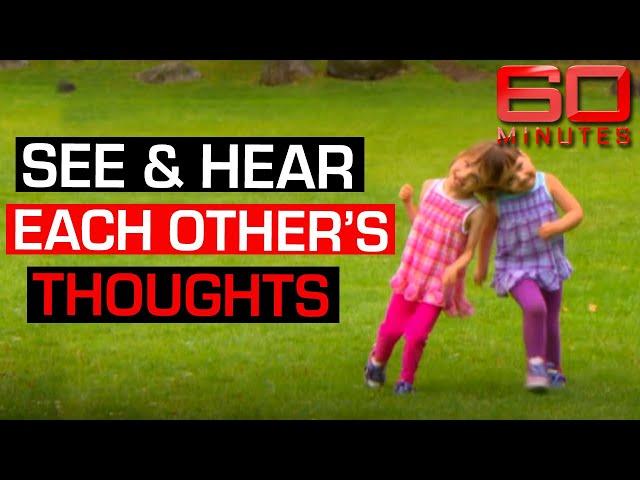 Conjoined twins share taste, sight, feelings and thoughts | 60 Minutes Australia