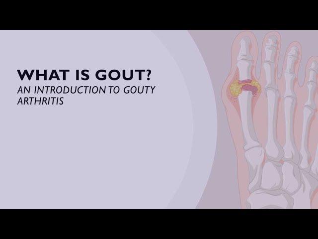 What is Gout? An Introduction to Gouty Arthritis (1 of 6)